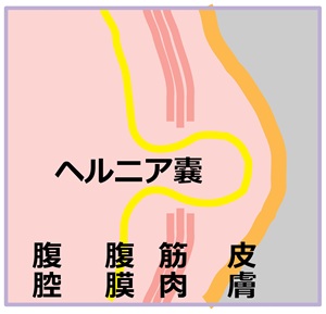 ヘルニアの構造