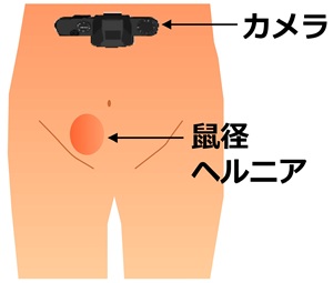 鼠径ヘルニア膨隆部の撮影時の構成