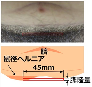 膨隆量の算出方法